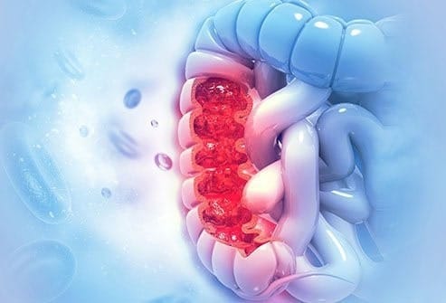 Ung thư hậu môn được chia thành 4 giai đoạn. (Ảnh minh họa sưu tầm)